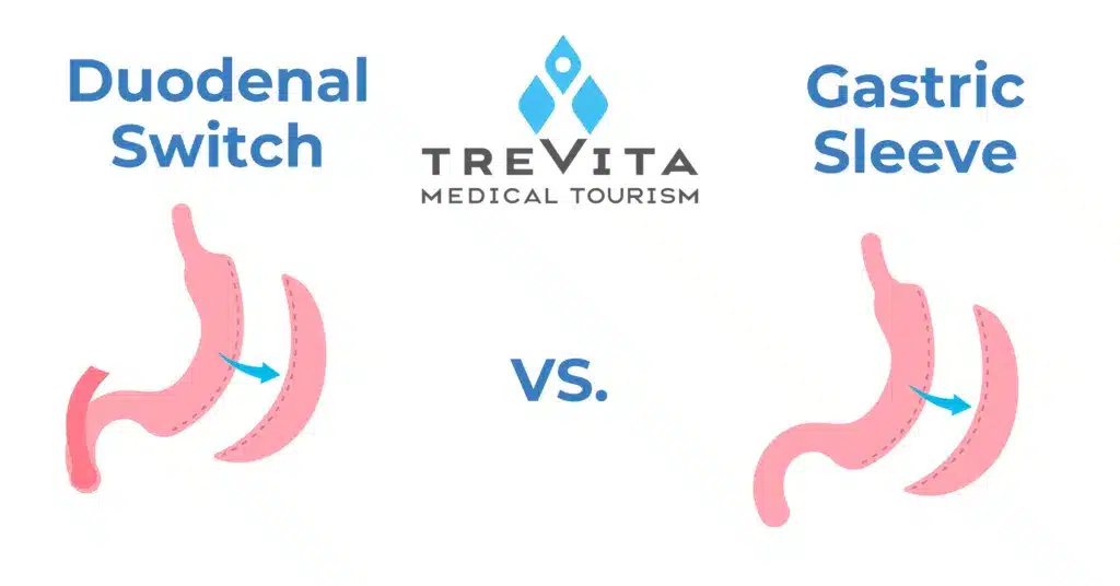 Duodenal Switch vs. Gastric Sleeve 