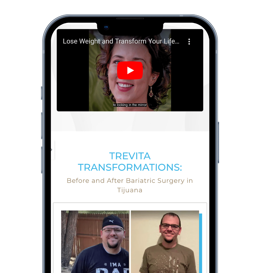 A side-by-side comparison of a patient's before and after photos showcasing their transformation after bariatric surgery in Tijuana.